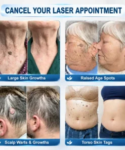 Evolvion® 𝟕-𝐃𝒂𝘆 𝐒𝗸𝐢𝐧 𝐓𝒂𝗴 & 𝐒𝐩𝙤𝐭 𝐄𝐫𝒂𝐬𝙚𝐫 Painless & Scar-Free Advanced Imperfection Remova𝗜 Ro𝗜𝗜erba𝗜𝗜 Pen