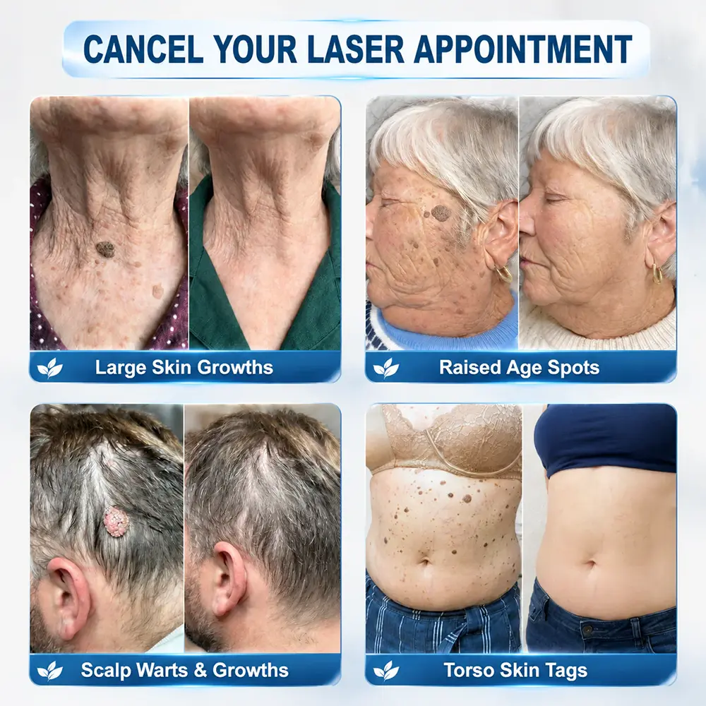 Evolvion® 𝟕-𝐃𝒂𝘆 𝐒𝗸𝐢𝐧 𝐓𝒂𝗴 & 𝐒𝐩𝙤𝐭 𝐄𝐫𝒂𝐬𝙚𝐫 Painless & Scar-Free Advanced Imperfection Remova𝗜 Ro𝗜𝗜erba𝗜𝗜 Pen
