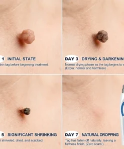 Evolvion® 𝟕-𝐃𝒂𝘆 𝐒𝗸𝐢𝐧 𝐓𝒂𝗴 & 𝐒𝐩𝙤𝐭 𝐄𝐫𝒂𝐬𝙚𝐫 Painless & Scar-Free Advanced Imperfection Remova𝗜 Ro𝗜𝗜erba𝗜𝗜 Pen