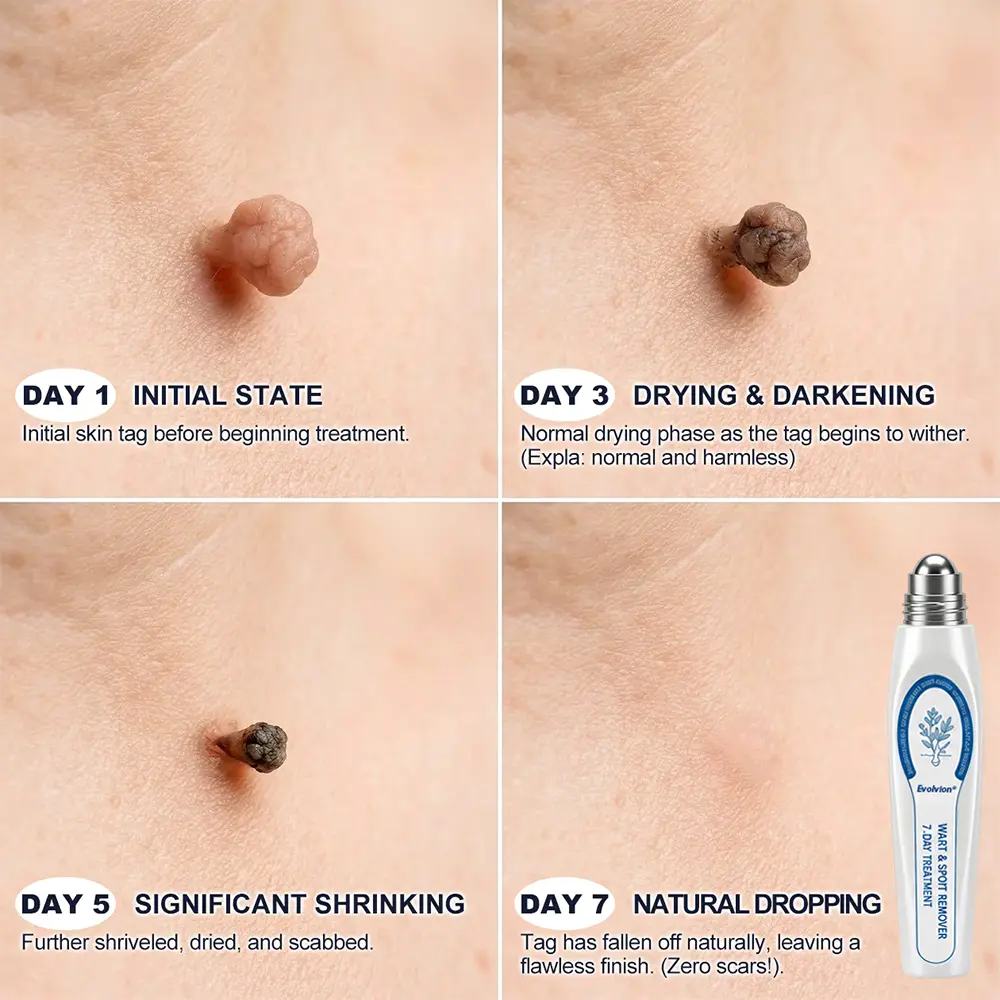 Evolvion® 𝟕-𝐃𝒂𝘆 𝐒𝗸𝐢𝐧 𝐓𝒂𝗴 & 𝐒𝐩𝙤𝐭 𝐄𝐫𝒂𝐬𝙚𝐫 Painless & Scar-Free Advanced Imperfection Remova𝗜 Ro𝗜𝗜erba𝗜𝗜 Pen