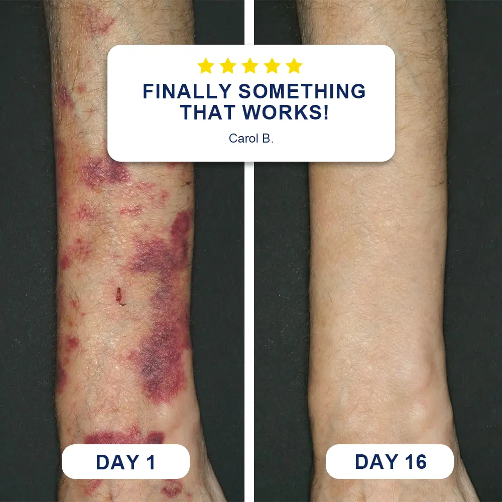 Evolvion® Bruise Repair & Skin-Strengthening Cream