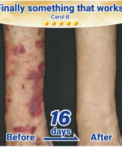 Evolvion® Senile Purpura, Bruise & Fragile Skin Repair Cream