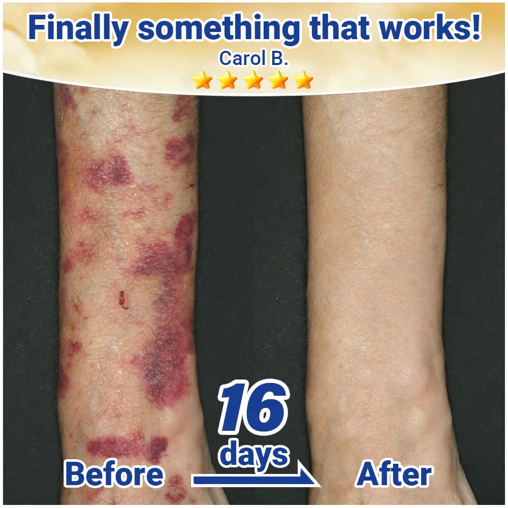 Evolvion® Senile Purpura, Bruise & Fragile Skin Repair Cream