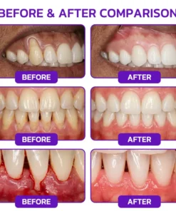 Evolvion® Bee Venom Gingivitis & Periodontitis Treatment Toothpaste